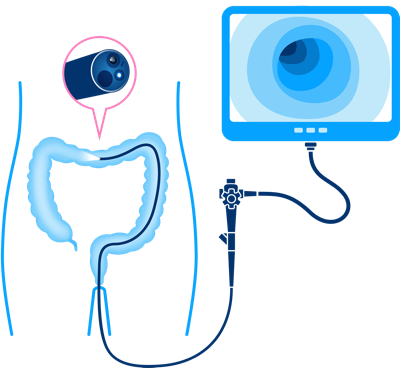 How to get screened - Colonoscopy