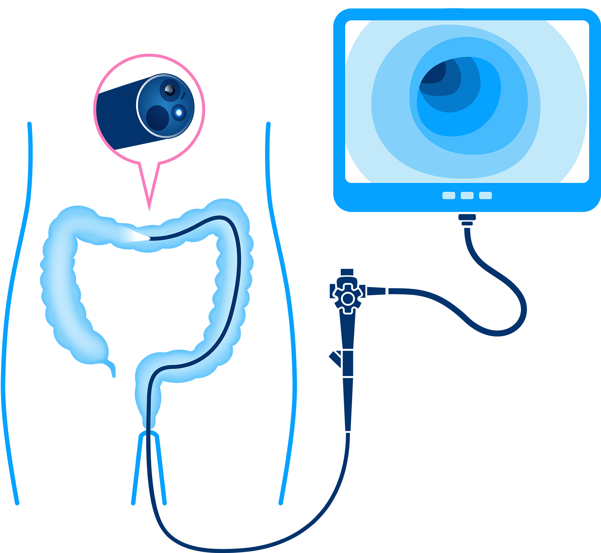 How to get screened - Colonoscopy