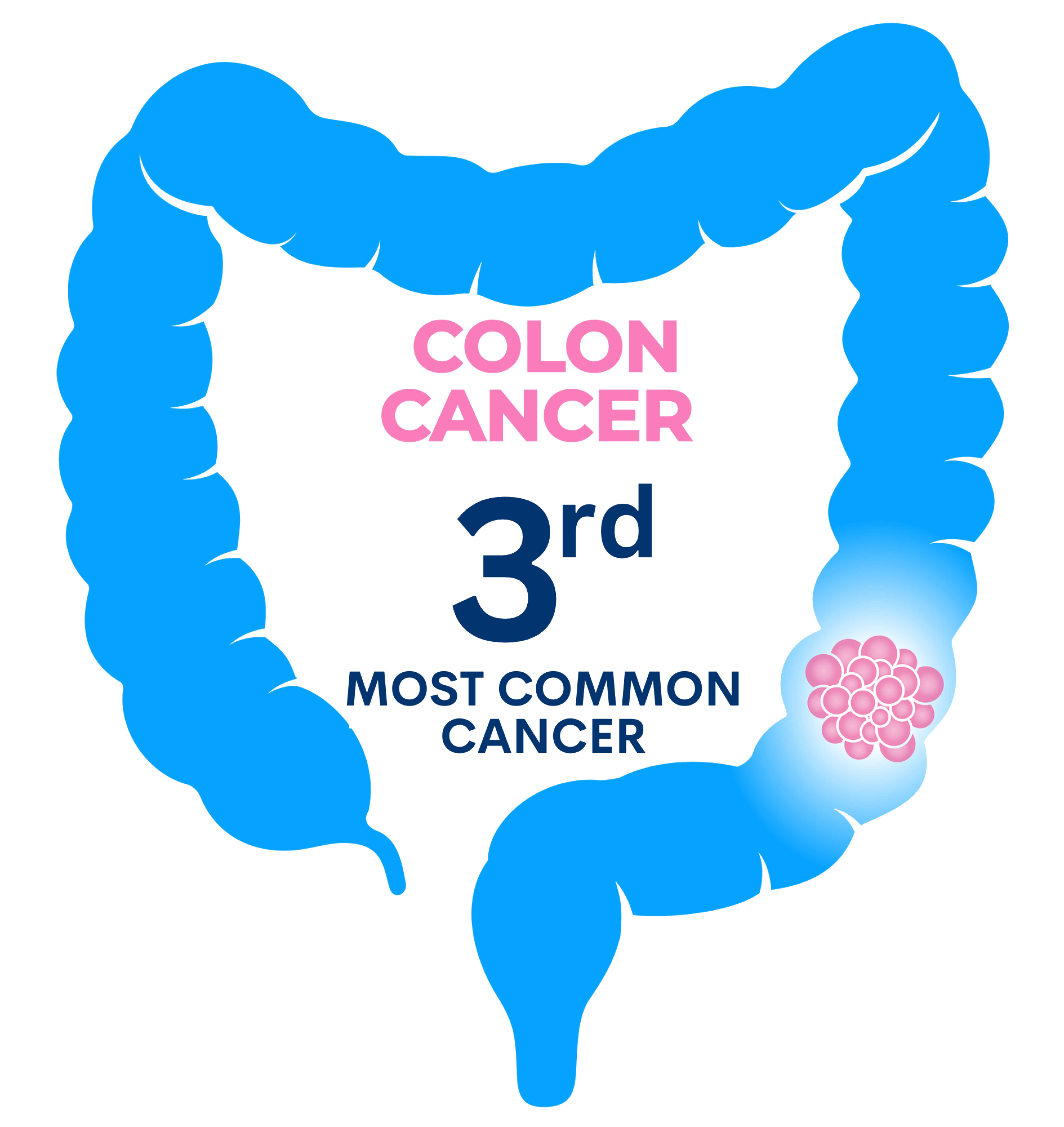 Colon cancer 3rd most common cancer