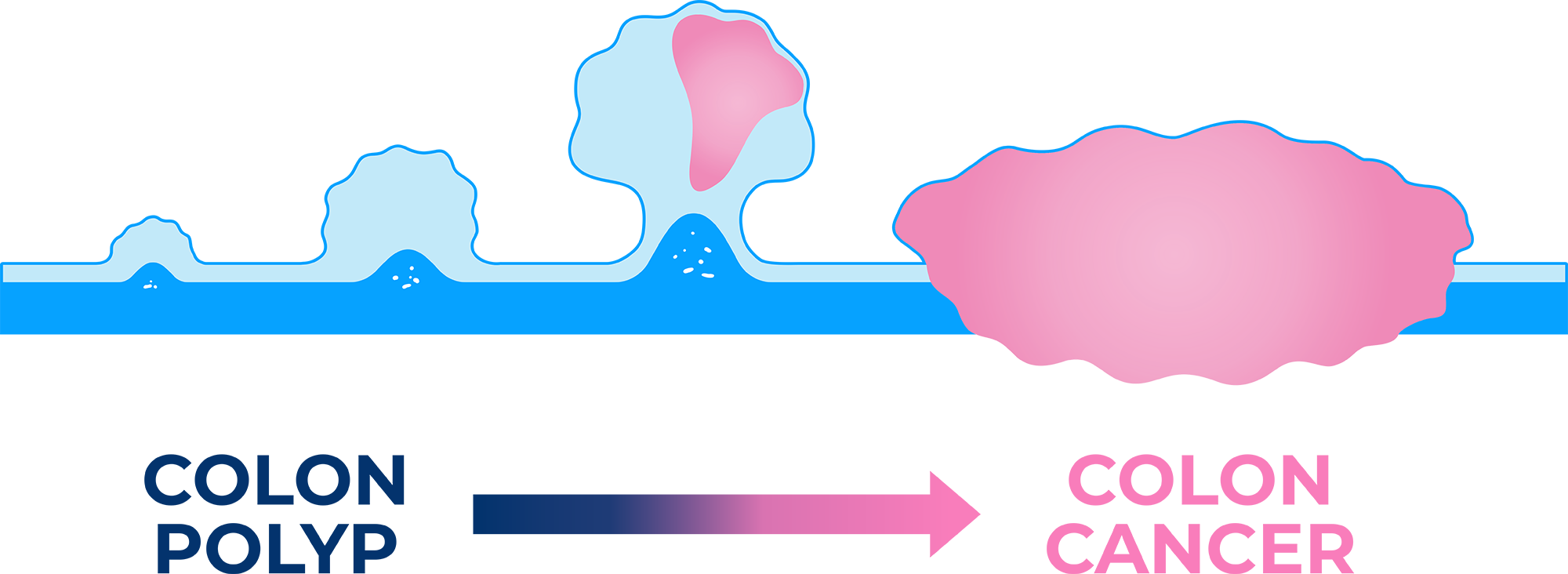 Colon Polyp